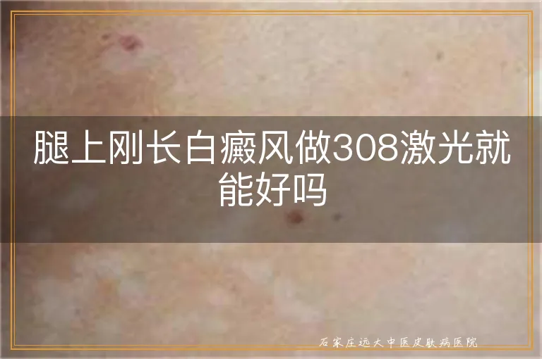 腿上刚长白癜风做308激光就能好吗