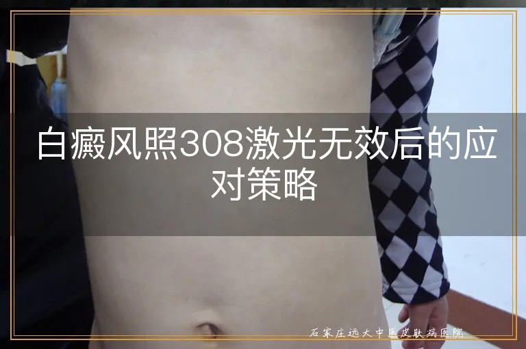 白癜风照308激光无效后的应对策略