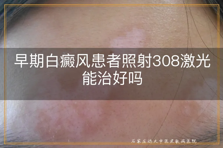 早期白癜风患者照射308激光能治好吗