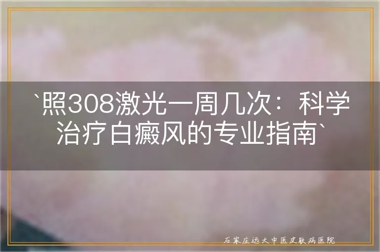 照308激光一周几次：科学治疗白癜风的专业指南