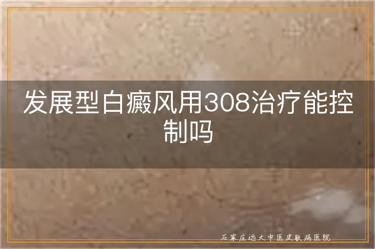 发展型白癜风用308治疗能控制吗