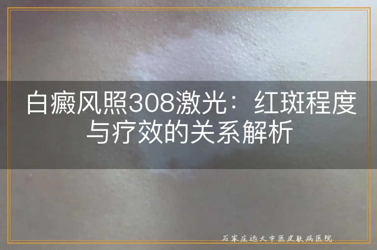 白癜风照308激光：红斑程度与疗效的关系解析