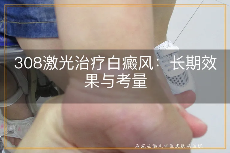 308激光治疗白癜风：长期效果与考量