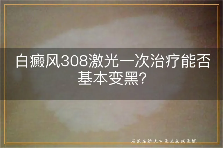 白癜风308激光一次治疗能否基本变黑？