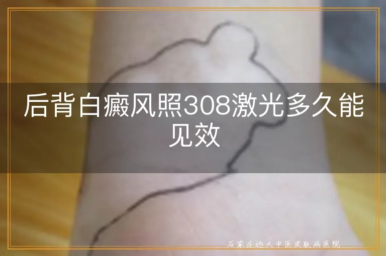 后背白癜风照308激光多久能见效