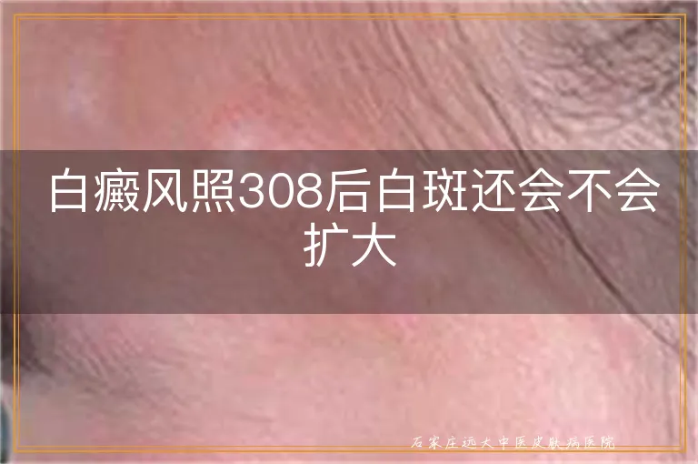 白癜风照308后白斑还会不会扩大