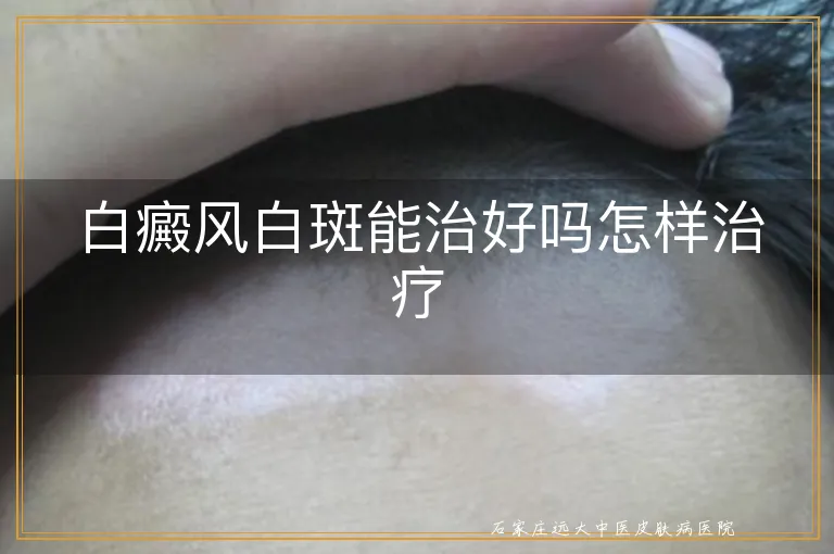 白癜风白斑能治好吗怎样治疗