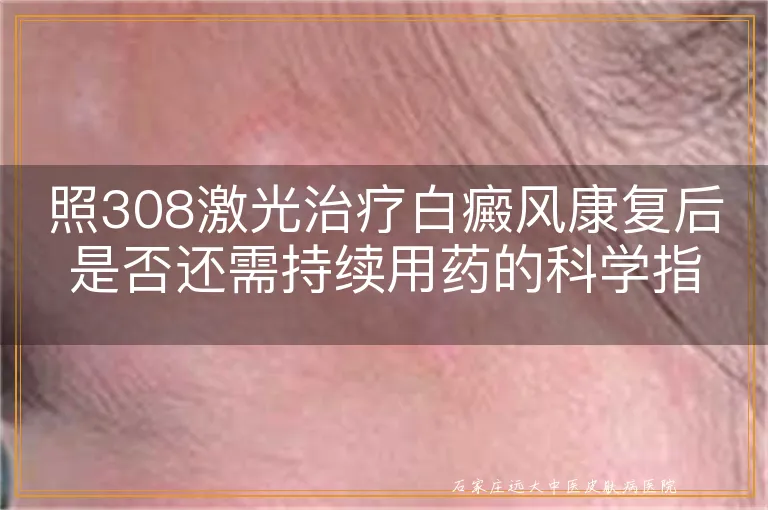 照308激光治疗白癜风康复后是否还需持续用药的科学指南