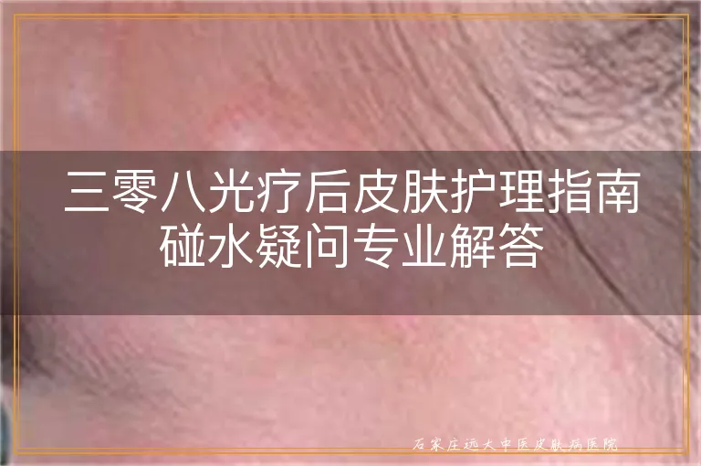 三零八光疗后皮肤护理指南碰水疑问专业解答