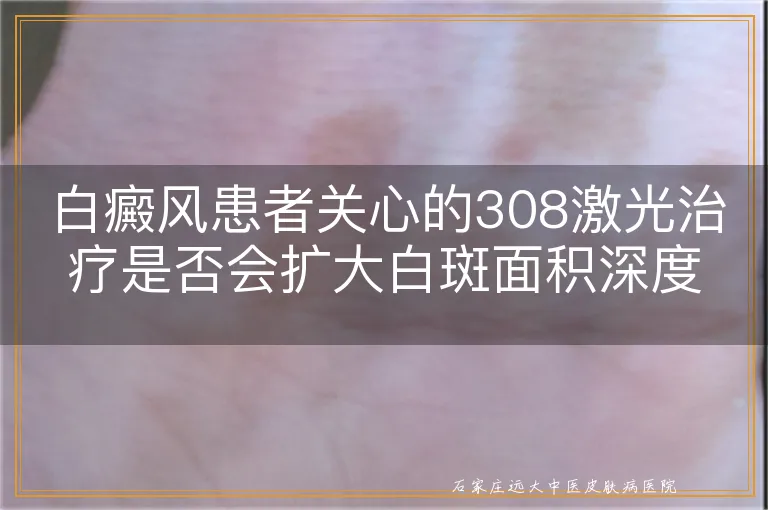 白癜风患者关心的308激光治疗是否会扩大白斑面积深度解读