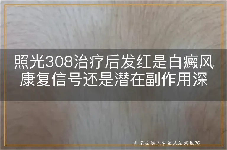 照光308治疗后发红是白癜风康复信号还是潜在副作用深度剖析