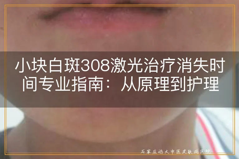 小块白斑308激光治疗消失时间专业指南：从原理到护理全面解析