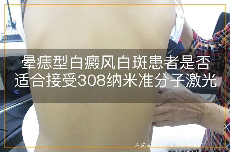 晕痣型白癜风白斑患者是否适合接受308纳米准分子激光治疗