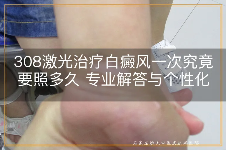 308激光治疗白癜风一次究竟要照多久 专业解答与个性化考量