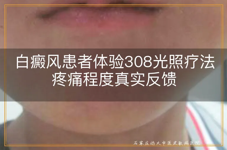 白癜风患者体验308光照疗法疼痛程度真实反馈