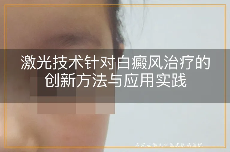 激光技术针对白癜风治疗的创新方法与应用实践