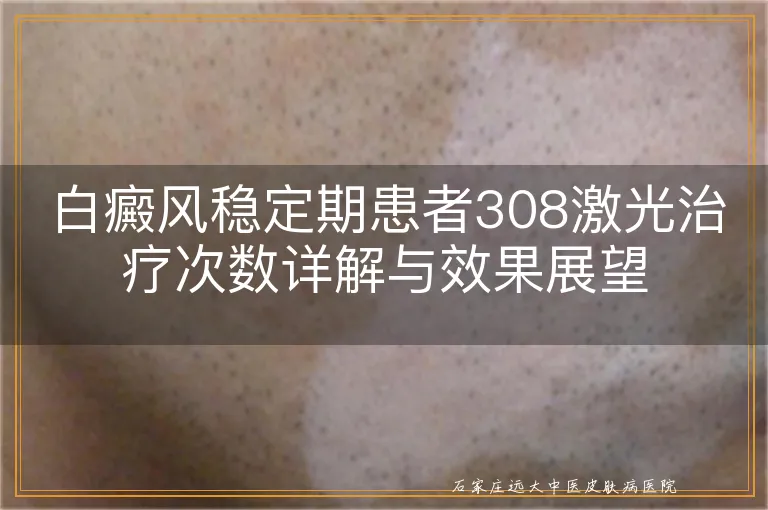 白癜风稳定期患者308激光治疗次数详解与效果展望