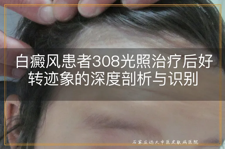 白癜风患者308光照治疗后好转迹象的深度剖析与识别