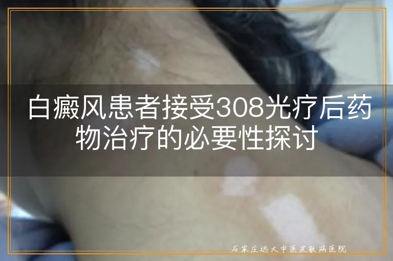 白癜风患者接受308光疗后药物治疗的必要性探讨