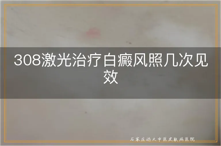 308激光治疗白癜风照几次见效