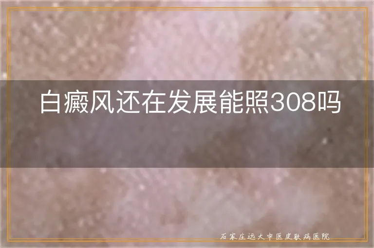 白癜风还在发展能照308吗