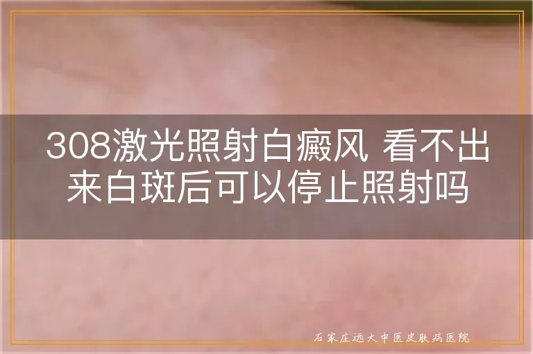 308激光照射白癜风 看不出来白斑后可以停止照射吗