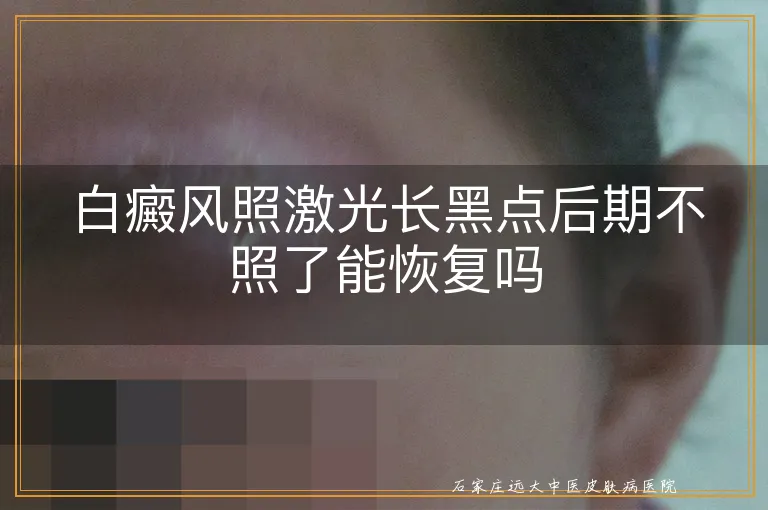 白癜风照激光长黑点后期不照了能恢复吗