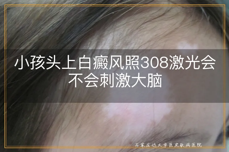 小孩头上白癜风照308激光会不会刺激大脑