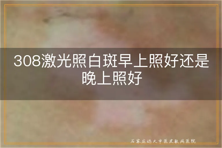 308激光照白斑早上照好还是晚上照好