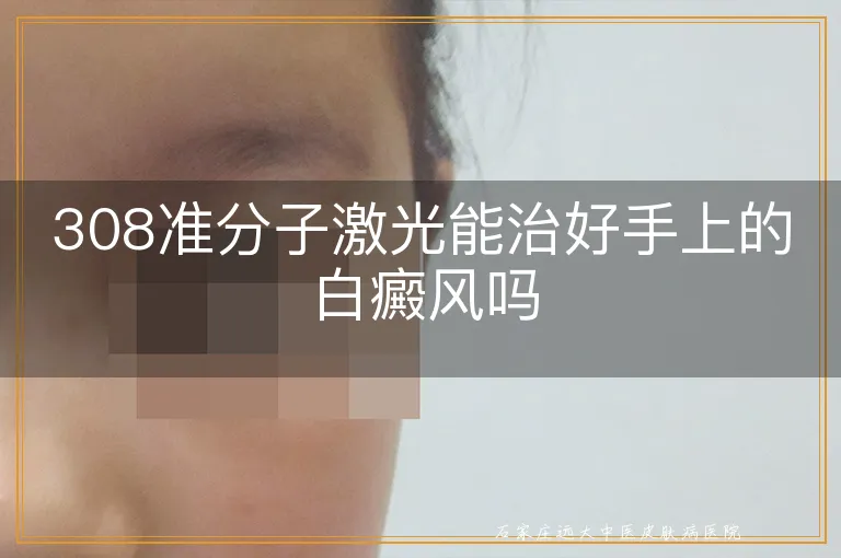 308准分子激光能治好手上的白癜风吗