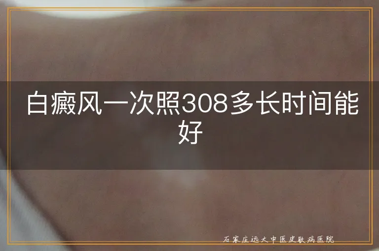 白癜风一次照308多长时间能好