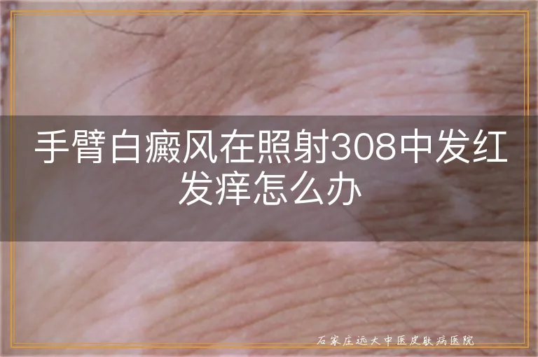 手臂白癜风在照射308中发红发痒怎么办