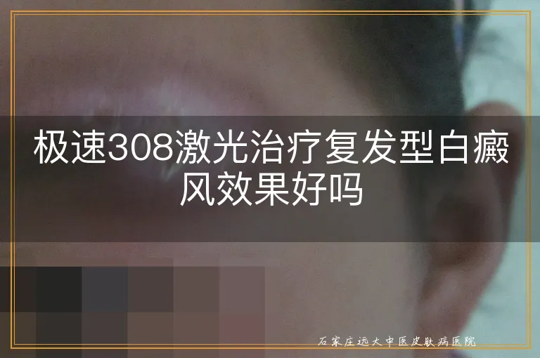 极速308激光治疗复发型白癜风效果好吗