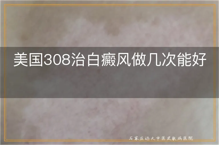 美国308治白癜风做几次能好