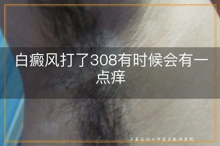 白癜风打了308有时候会有一点痒