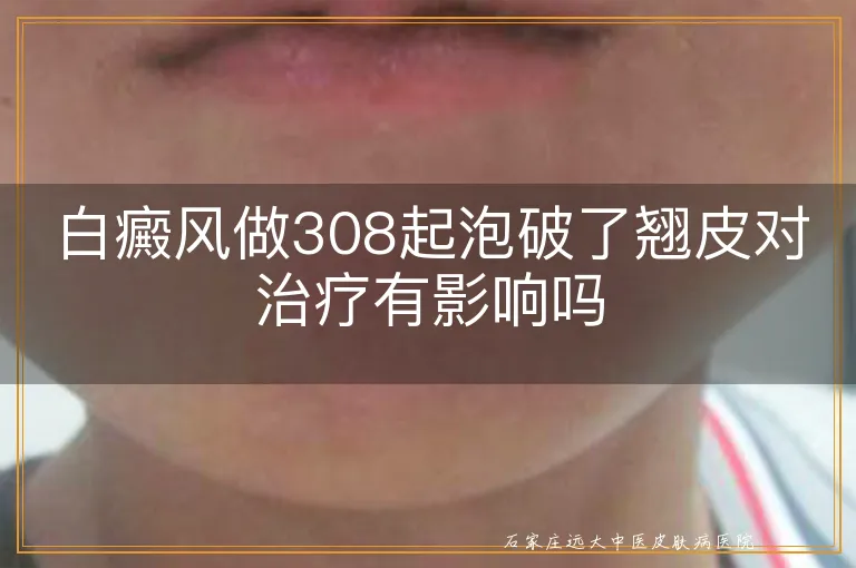 白癜风做308起泡破了翘皮对治疗有影响吗