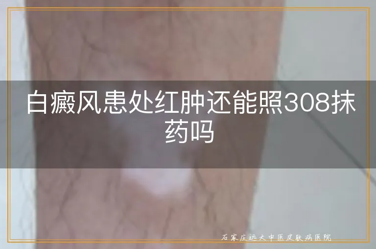 白癜风患处红肿还能照308抹药吗