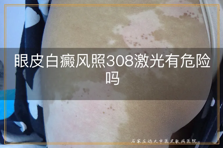 眼皮白癜风照308激光有危险吗