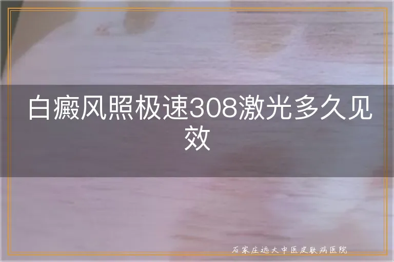 白癜风照极速308激光多久见效