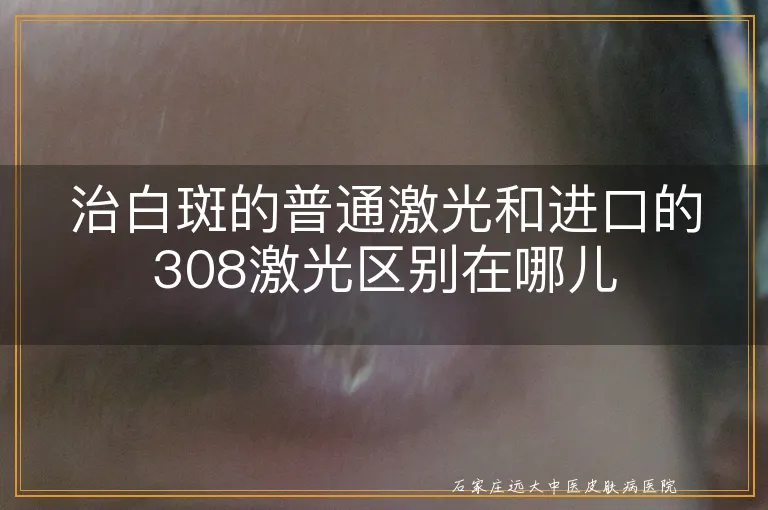 治白斑的普通激光和进口的308激光区别在哪儿