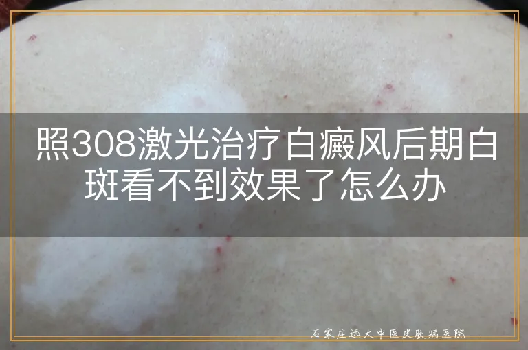 照308激光治疗白癜风后期白斑看不到效果了怎么办