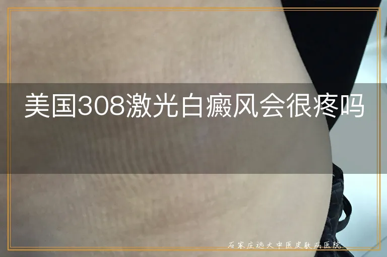 美国308激光白癜风会很疼吗