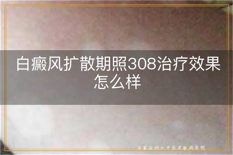 白癜风扩散期照308治疗效果怎么样