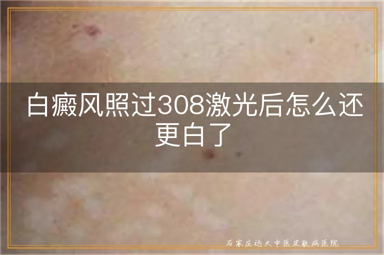 白癜风照过308激光后怎么还更白了