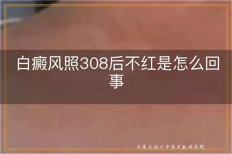 白癜风照308后不红是怎么回事