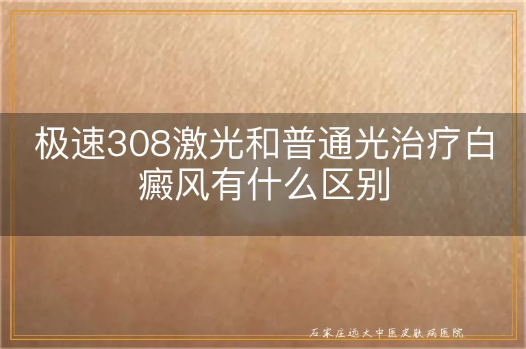 极速308激光和普通光治疗白癜风有什么区别