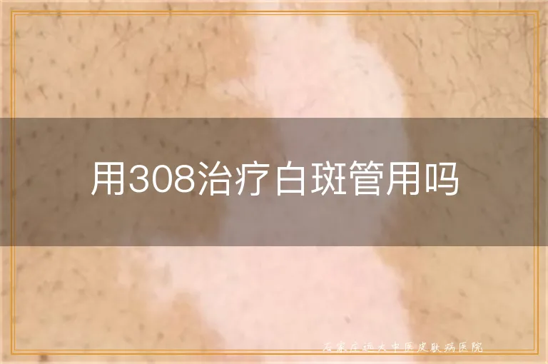 用308治疗白斑管用吗