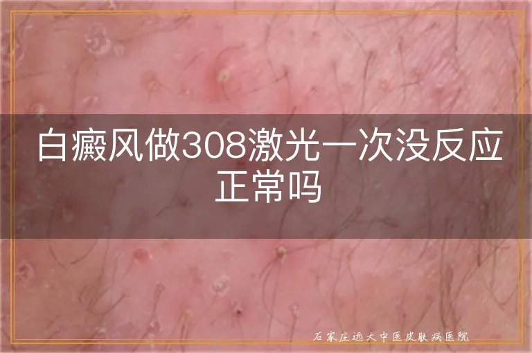 白癜风做308激光一次没反应正常吗