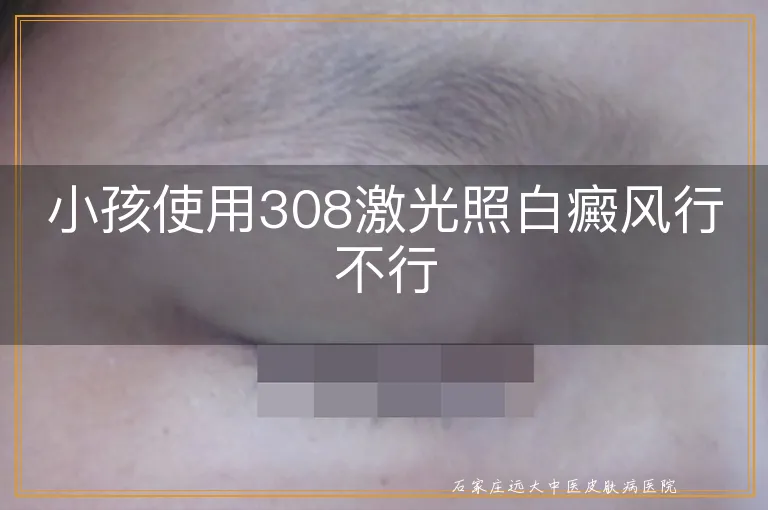 小孩使用308激光照白癜风行不行