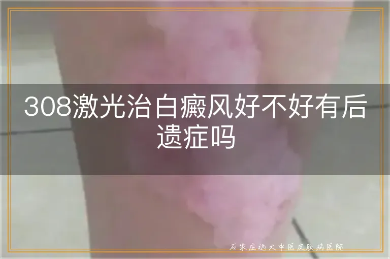 308激光治白癜风好不好有后遗症吗